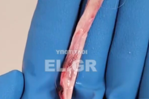 ΤΕΡΑΣΤΙΟΙ ΘΡΟΜΒΟΙ!!! Δείτε τι βγαίνει μέσα από ανθρώπινα σώματα – ΒΙΝΤΕΟ