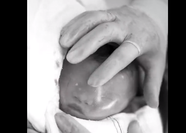 ΜΟΝΑΔΙΚΟ ΒΙΝΤΕΟ: Μωρό γεννάται σε ΑΘΙΚΤΟ ΑΜΝΙΑΚΟ ΣΑΚΟ – Δείτε πως τον σπάνε