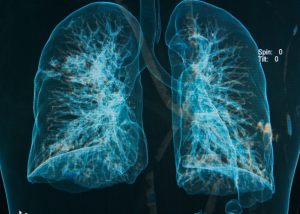 Ο προσυμπτωματικός έλεγχος για καρκίνο του πνεύμονα βελτιώνει σημαντικά τη μακροπρόθεσμη επιβίωση των ασθενών